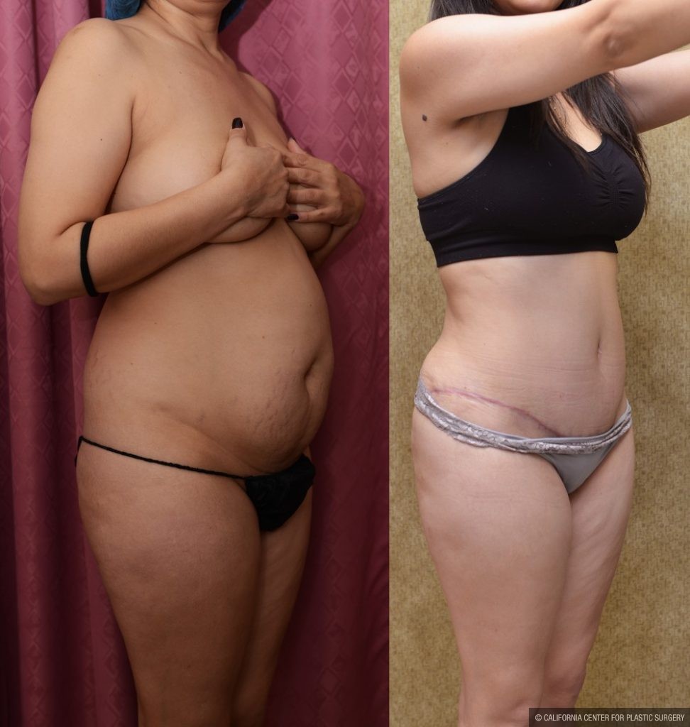 Tummy Tuck (Abdominoplasty) Small Size Before & After Patient #13488