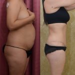 Tummy Tuck (Abdominoplasty) Small Size Before & After Patient #13488