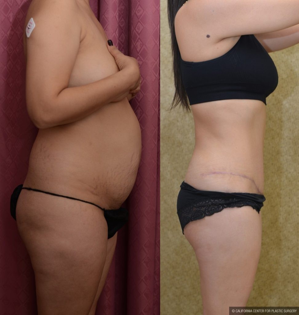 Tummy Tuck (Abdominoplasty) Small Size Before & After Patient #13488
