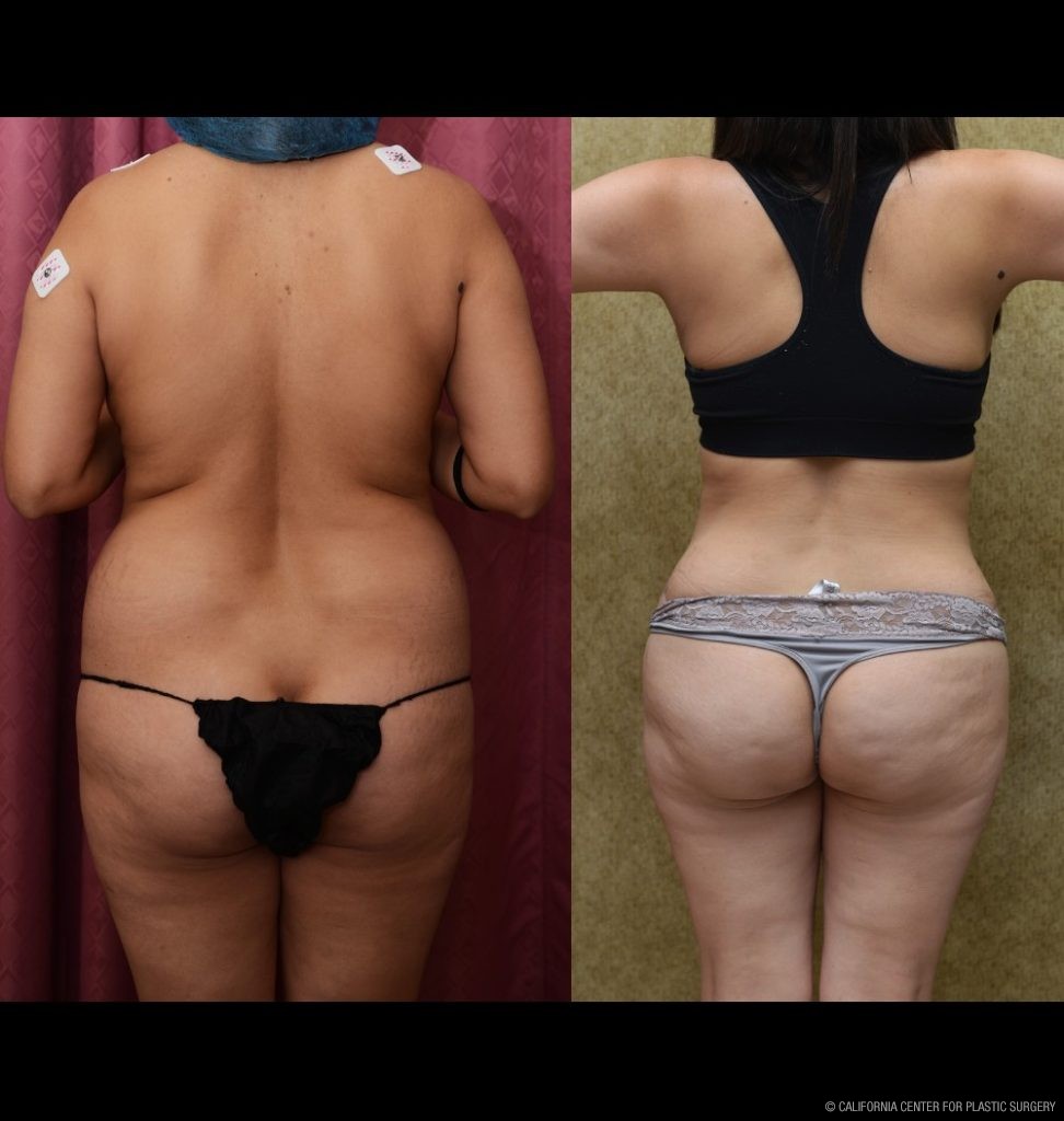 Tummy Tuck (Abdominoplasty) Small Size Before & After Patient #13488