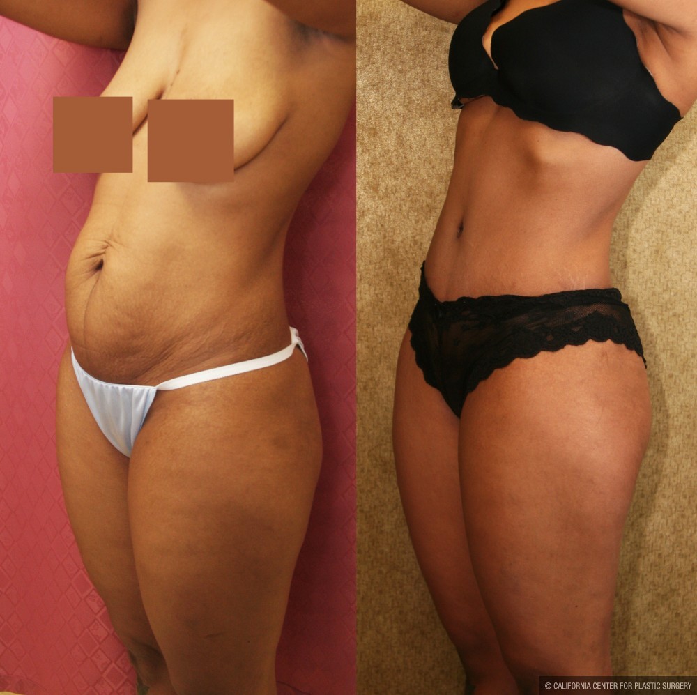 Tummy Tuck (Abdominoplasty) Small Size Before & After Patient #13484