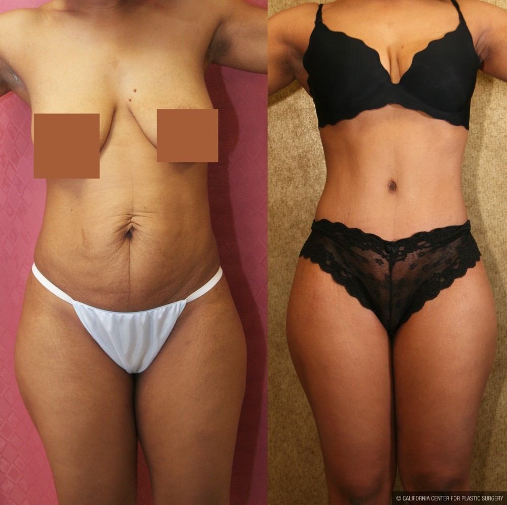 Tummy Tuck (Abdominoplasty) Small Size Before & After Patient #13484