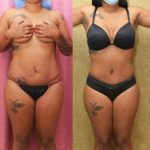African American Tummy Tuck (Abdominoplasty) Before & After Patient #13447