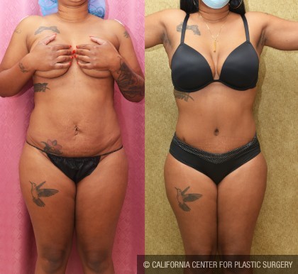 African American Tummy Tuck (Abdominoplasty) Before & After Patient #13447