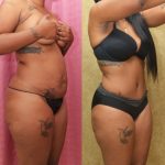 African American Tummy Tuck (Abdominoplasty) Before & After Patient #13447