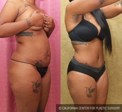 African American Tummy Tuck (Abdominoplasty) Before & After Patient #13447