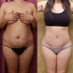 Tummy Tuck (Abdominoplasty) Small Size Before & After Patient #13488