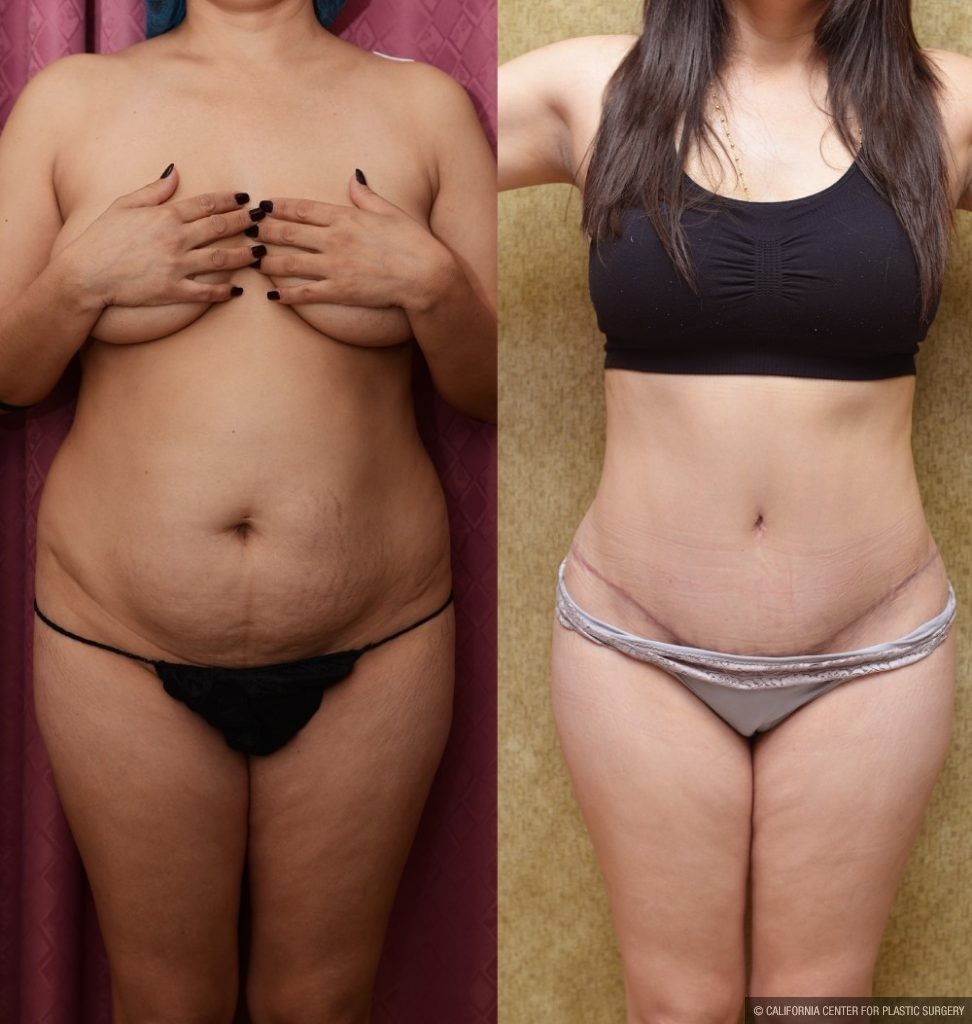 Tummy Tuck (Abdominoplasty) Small Size Before & After Patient #13488