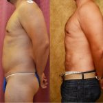 Male Liposuction Abdomen Before & After Patient #13420