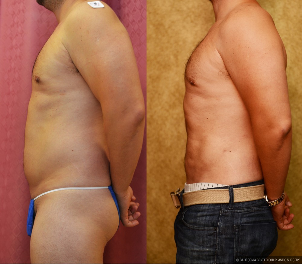 Male Liposuction Abdomen Before & After Patient #13420