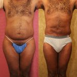 Male Liposuction Abdomen Before & After Patient #13415