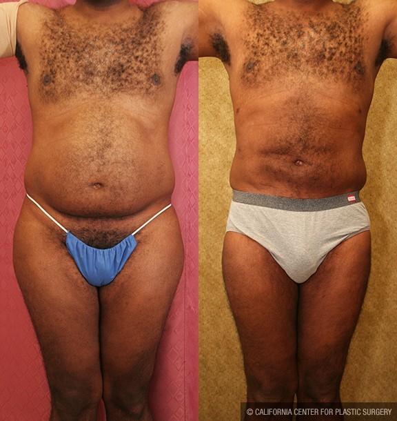 Male Liposuction Abdomen Before & After Patient #13415