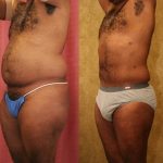 Male Liposuction Abdomen Before & After Patient #13415