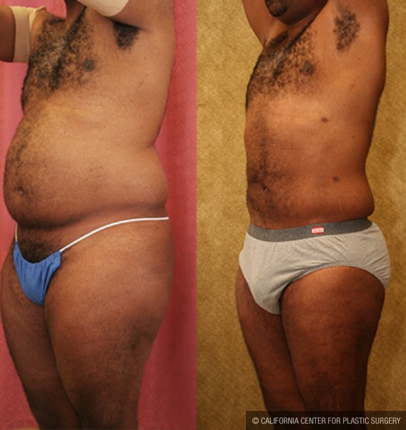 Male Liposuction Abdomen Before & After Patient #13415