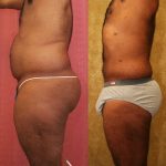 Male Liposuction Abdomen Before & After Patient #13415