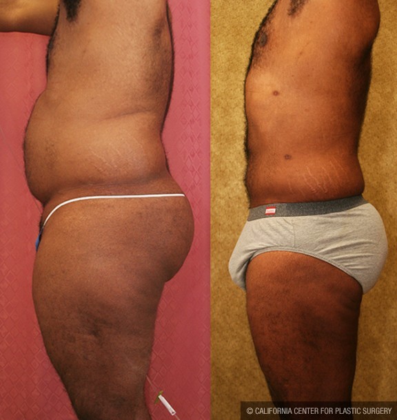 Male Liposuction Abdomen Before & After Patient #13415