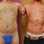 Male Liposuction Abdomen Before & After Patient #13420