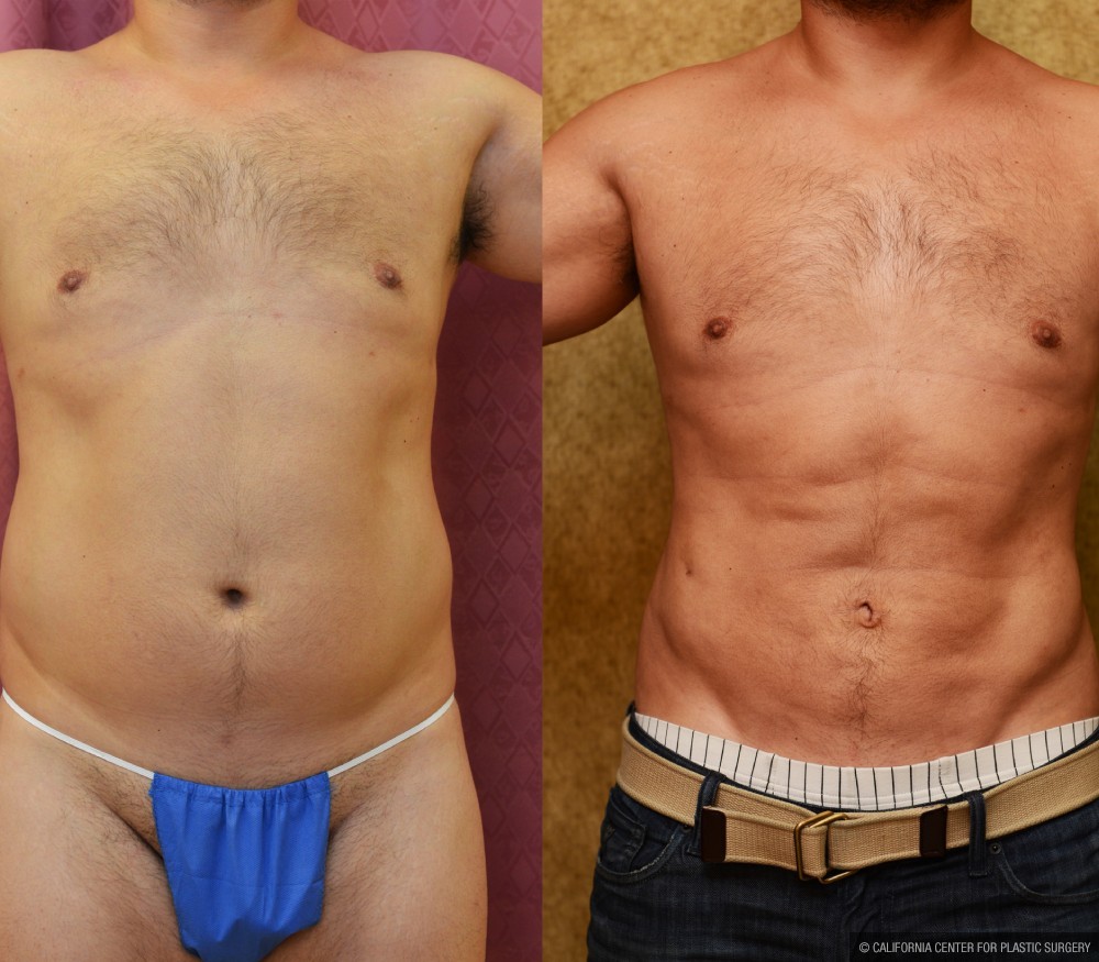 Male Liposuction Abdomen Before & After Patient #13420