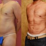 Male Liposuction Abdomen Before & After Patient #13420