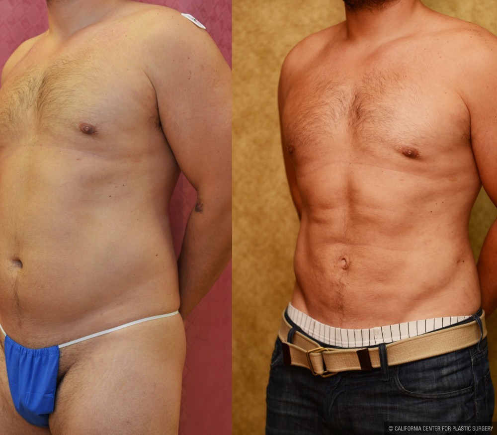 Male Liposuction Abdomen Before & After Patient #13420