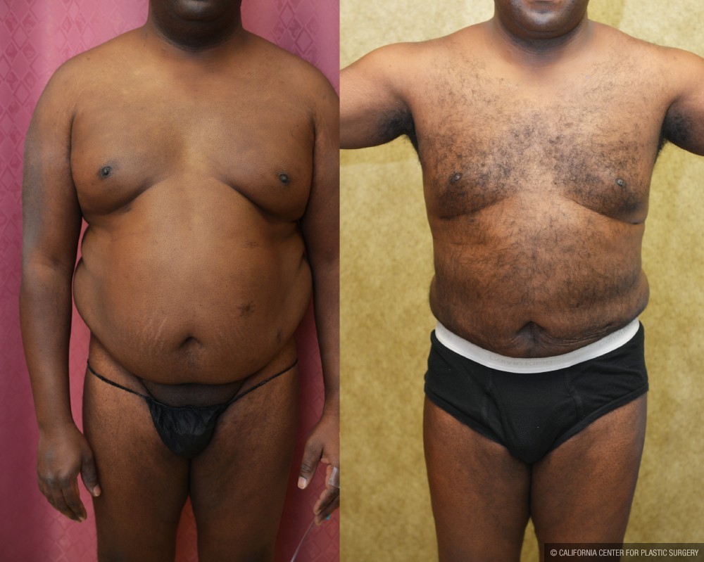 Male Liposuction Abdomen Before & After Patient #13411