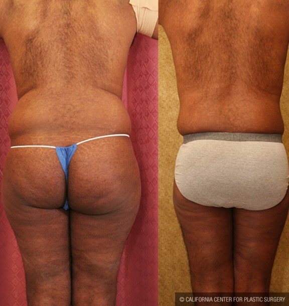 Male Liposuction Abdomen Before & After Patient #13415