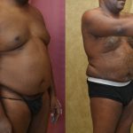 Male Liposuction Abdomen Before & After Patient #13411