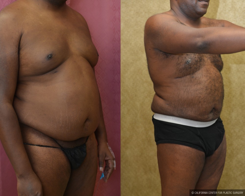 Male Liposuction Abdomen Before & After Patient #13411