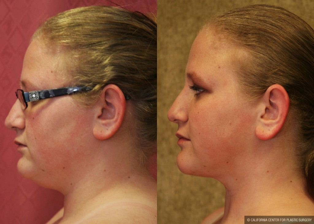 Neck & Face Liposuction Before & After Patient #13355