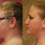 Neck & Face Liposuction Before & After Patient #13355