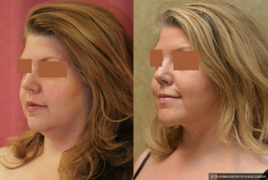 Neck & Face Liposuction Before & After Patient #13398