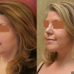 Neck & Face Liposuction Before & After Patient #13398