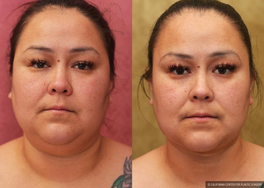 Neck & Face Liposuction Before & After Patient #13351