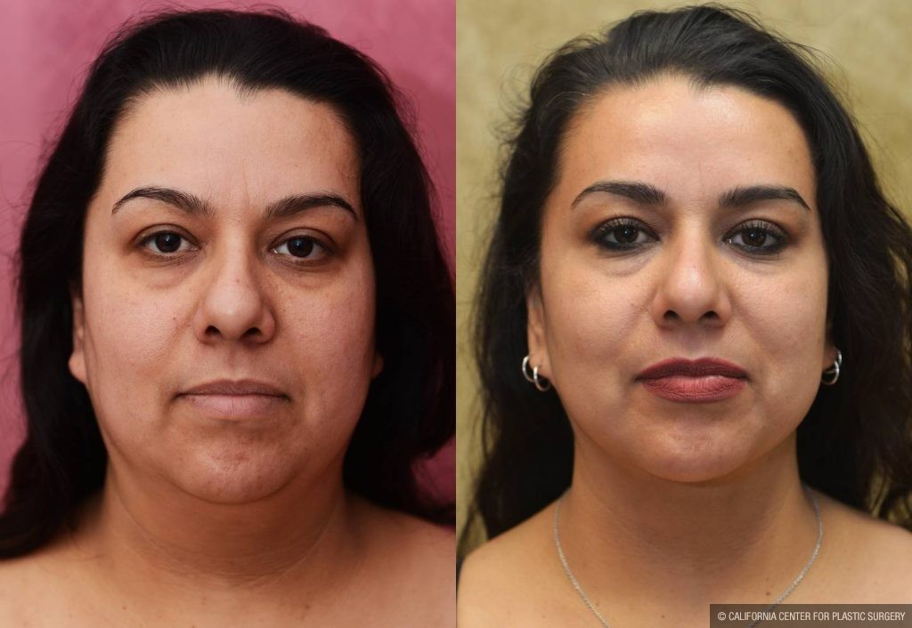 Neck & Face Liposuction Before & After Patient #13347