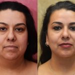 Neck & Face Liposuction Before & After Patient #13347