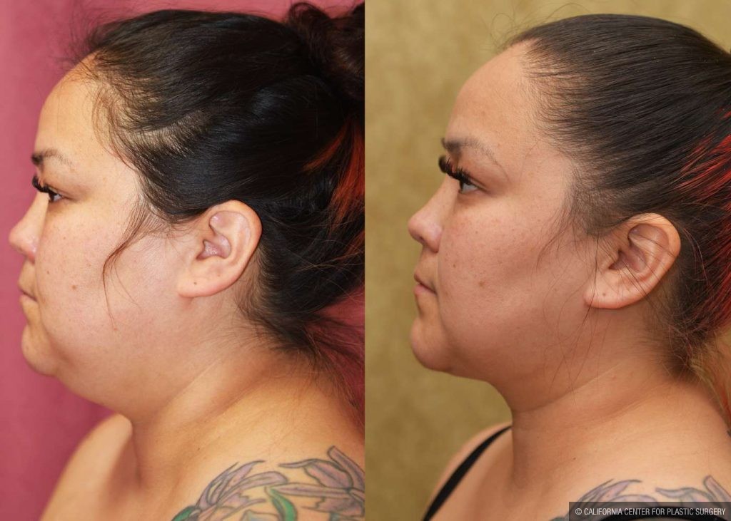 Neck & Face Liposuction Before & After Patient #13351