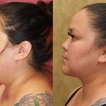 Neck & Face Liposuction Before & After Patient #13351
