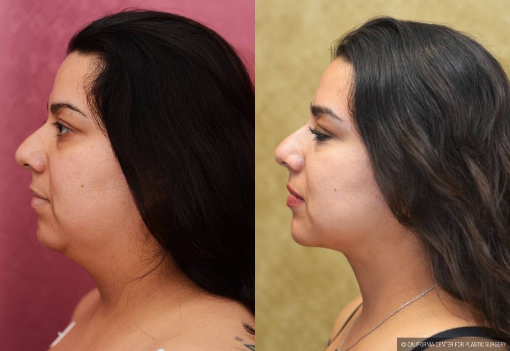 Neck & Face Liposuction Before & After Patient #13347