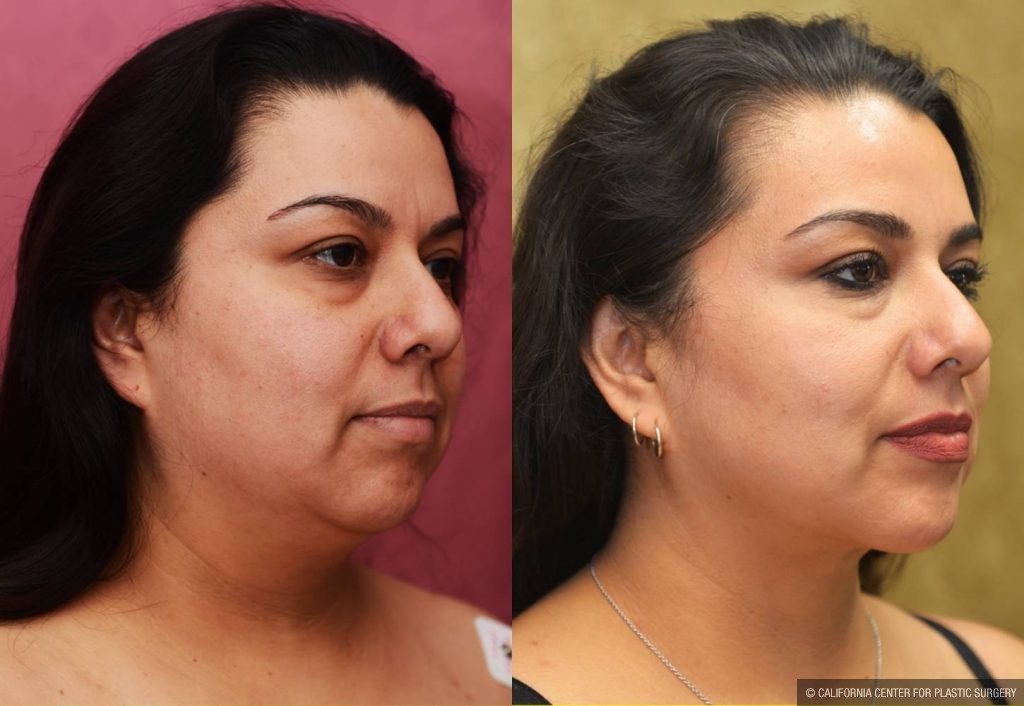 Neck & Face Liposuction Before & After Patient #13347