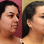 Neck & Face Liposuction Before & After Patient #13347