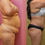 African American Tummy Tuck (Abdominoplasty) Before & After Patient #13460