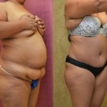 African American Tummy Tuck (Abdominoplasty) Before & After Patient #13460