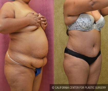 African American Tummy Tuck (Abdominoplasty) Before & After Patient #13460