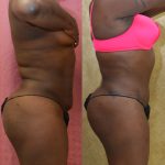 African American Tummy Tuck (Abdominoplasty) Before & After Patient #13439