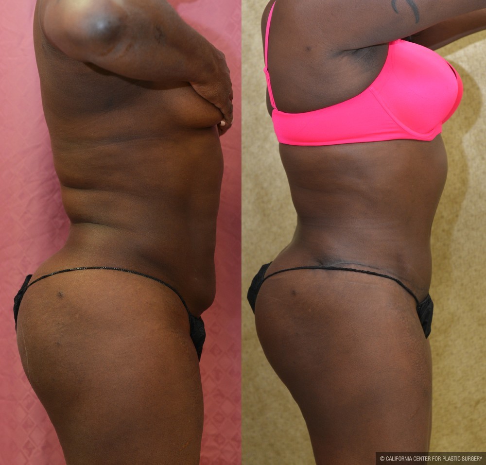 African American Tummy Tuck (Abdominoplasty) Before & After Patient #13439