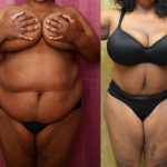 African American Tummy Tuck (Abdominoplasty) Before & After Patient #13434