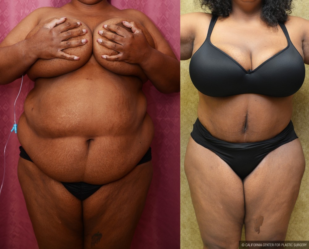 African American Tummy Tuck (Abdominoplasty) Before & After Patient #13434