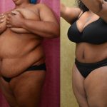 African American Tummy Tuck (Abdominoplasty) Before & After Patient #13434