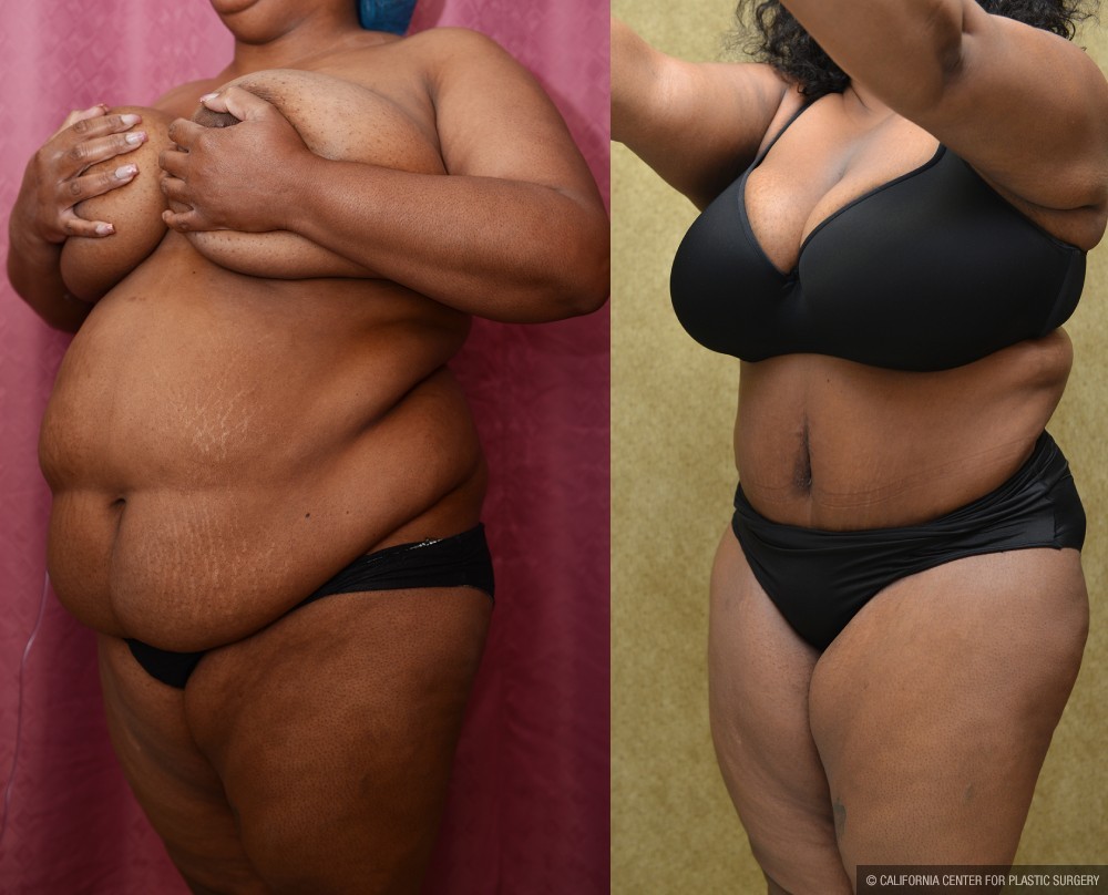 African American Tummy Tuck (Abdominoplasty) Before & After Patient #13434