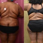 African American Tummy Tuck (Abdominoplasty) Before & After Patient #13434